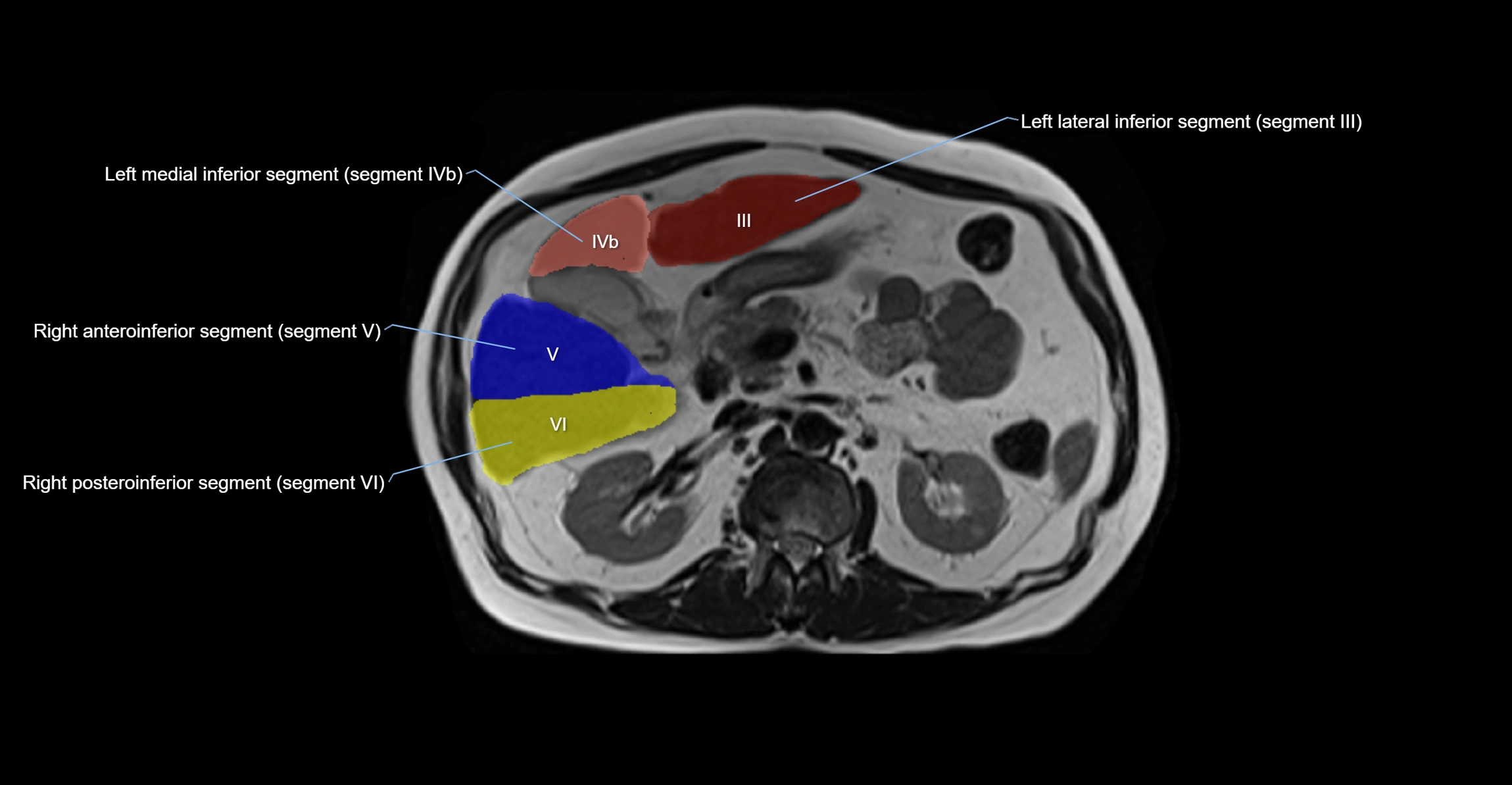 MRI  liver segments anatomy axial cross sectional 3T radiology  image-img-00001-00019.webp